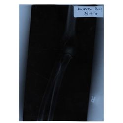 One-of-a-Kind Evel Knievel Right Elbow X-Ray -- Taken After the Daredevil's Disastrous 1975 Wembley