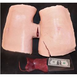 CONJOINED TWINS DUAL BODY SEPERATION SURGERY WITH LIVER