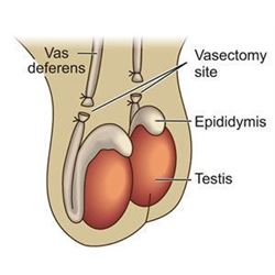 His Package Vasectomy