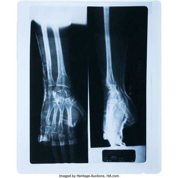 Elvis Presley X-Ray of Broken Wrist (1973). An X-ray of a broken wrist on the le