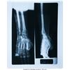 Image 1 : Elvis Presley X-Ray of Broken Wrist (1973). An X-ray of a broken wrist on the le
