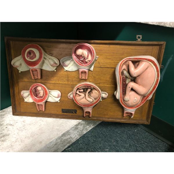 1920's Gynecologist/Pediatric fetus progression display w/ original oak & chalkware - Used by aborti