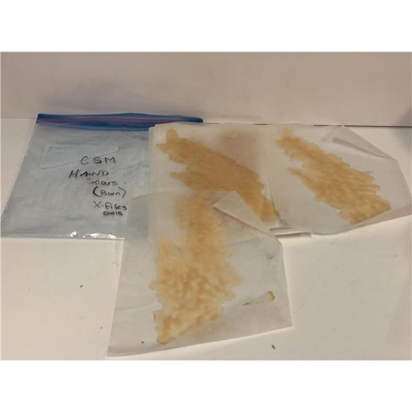 "X-Files" - Hand scars and burns 2015