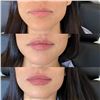 Image 2 : Restylane Kysse Lip Filler & Dysport treatment at Honolulu Med Spa