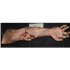 Image 1 : SEVERED ARM WITH COMPOUND FRACTURE