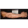 Image 2 : SEVERED ARM WITH COMPOUND FRACTURE