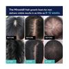 Image 6 : 3 Boxes of Sunheal 5% Minoxidil Hair Growth Foam for Men; Reduces Hair Loss/Restores Thinning - New