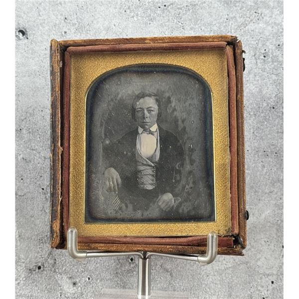 Daguerreotype Photo of Boy With Prosthetic Hand