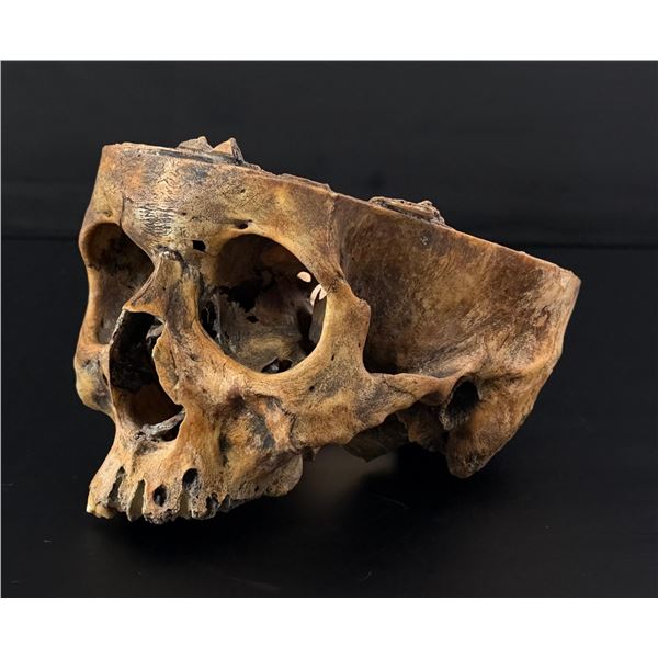 Antique Human Medical Autopsy Skull