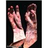 Image 2 : Nip/Tuck (2003-2010) Prosthetic Burnt Hands